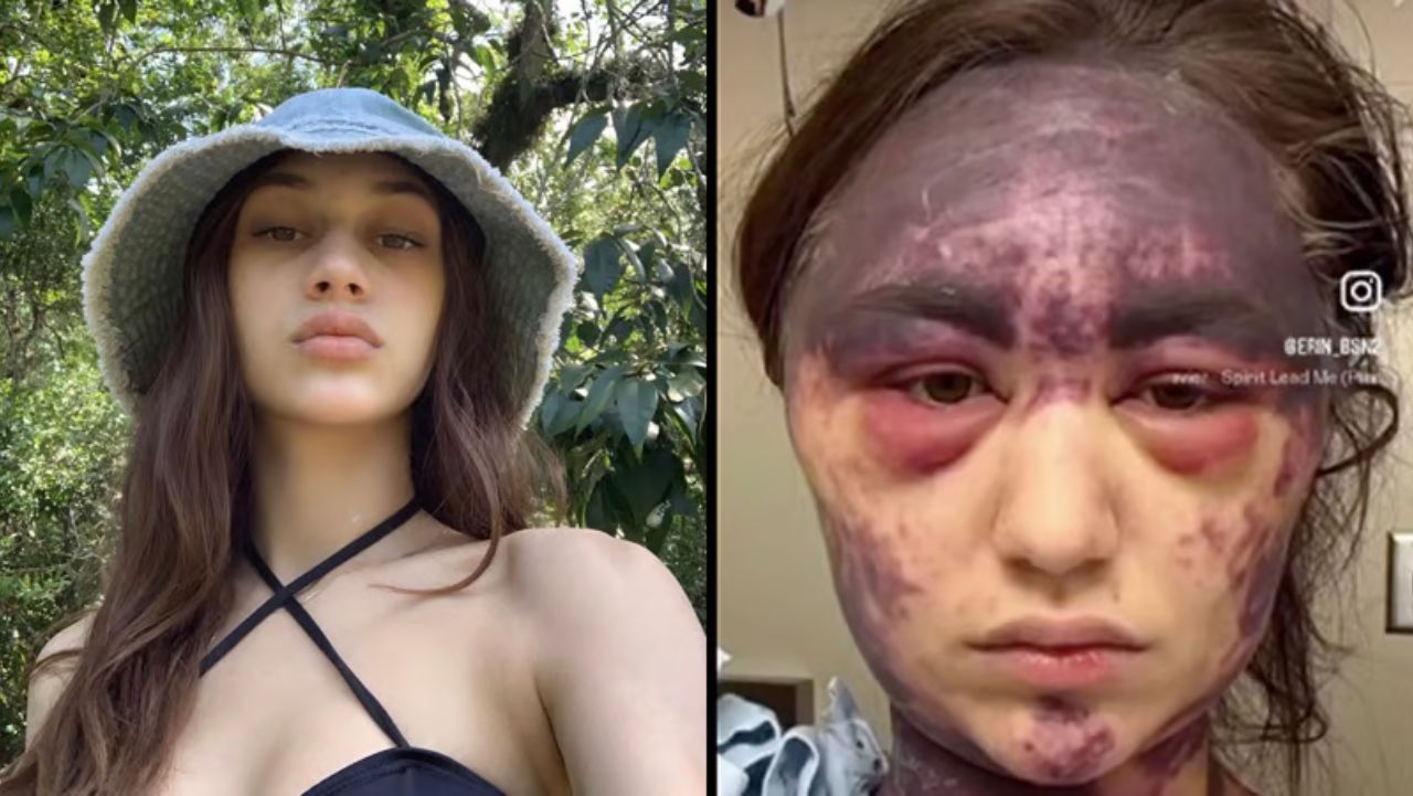 Woman Suffers HORRIFIC Injuries After Receiving Meningitis, Pneumonia & Tetanus Vaccines AT THE SAME TIME!